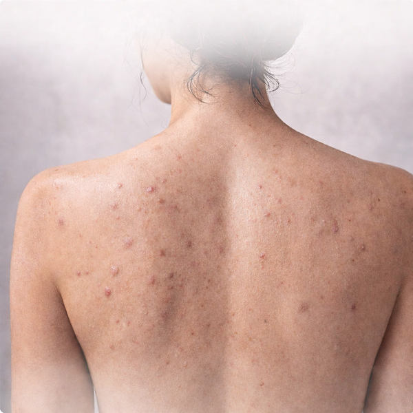 Avant — peau avant utilisation serviette ReliefVital